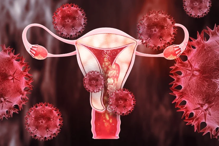 Uterine Cancer